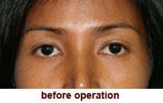 plastic-surgery-blepharoplasty